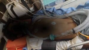 16 साल के दलित बच्चे को थर्ड डिग्री, जयपुर अस्पताल में वेंटिलेटर पर भर्ती